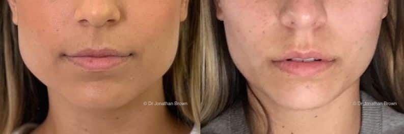 Facial jawline slimming before after picture