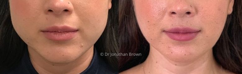 Jawline facial slimming before and after photo